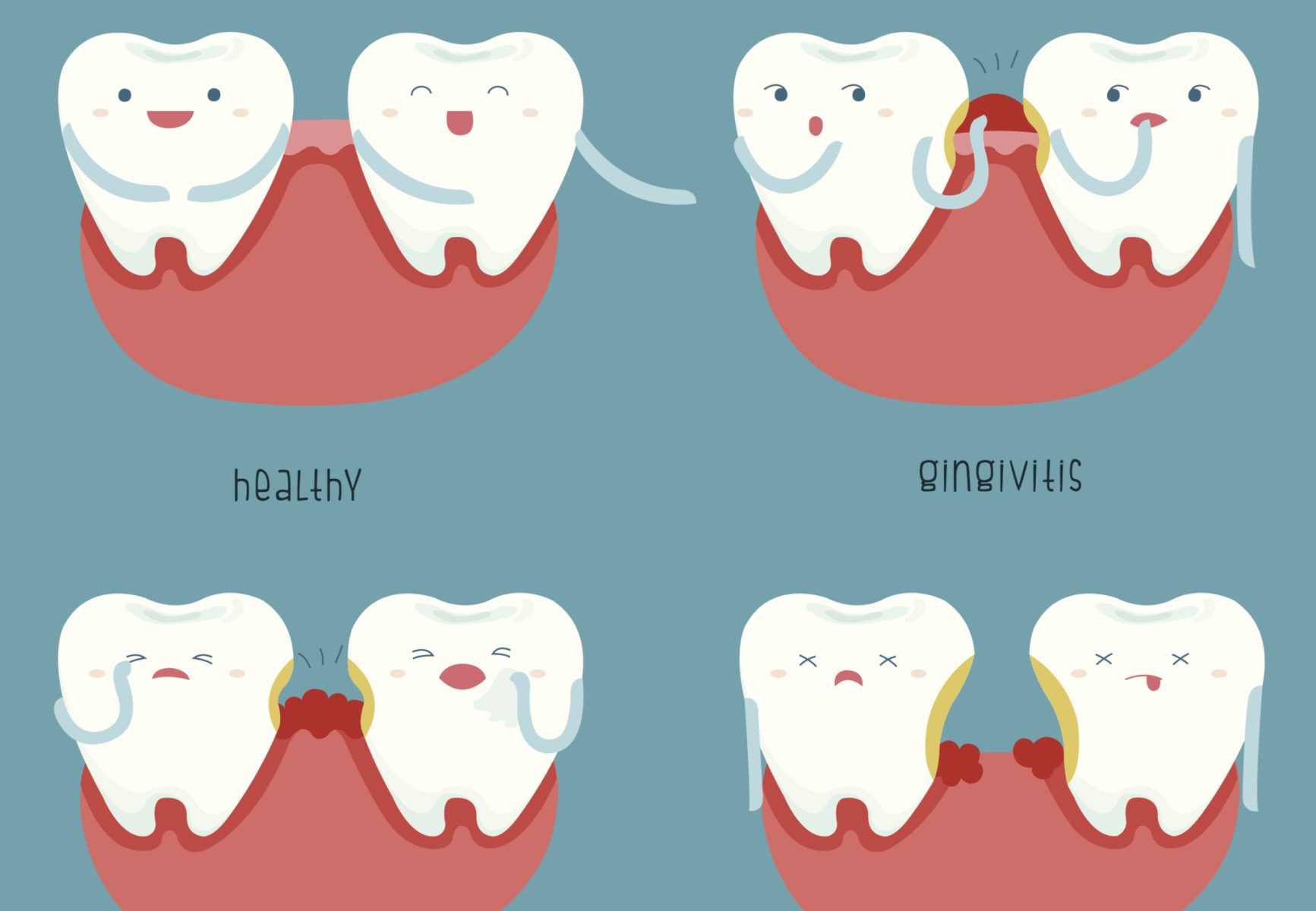 An infographic depicting the stages of periodontal disease