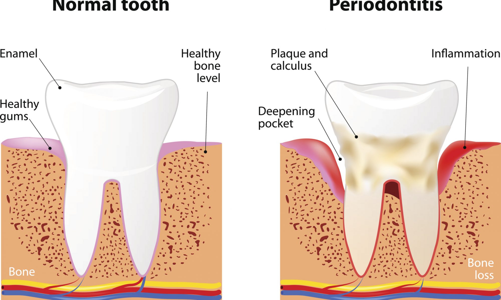 A detailed image depicting a normal tooth against a tooth infected with periodontitis