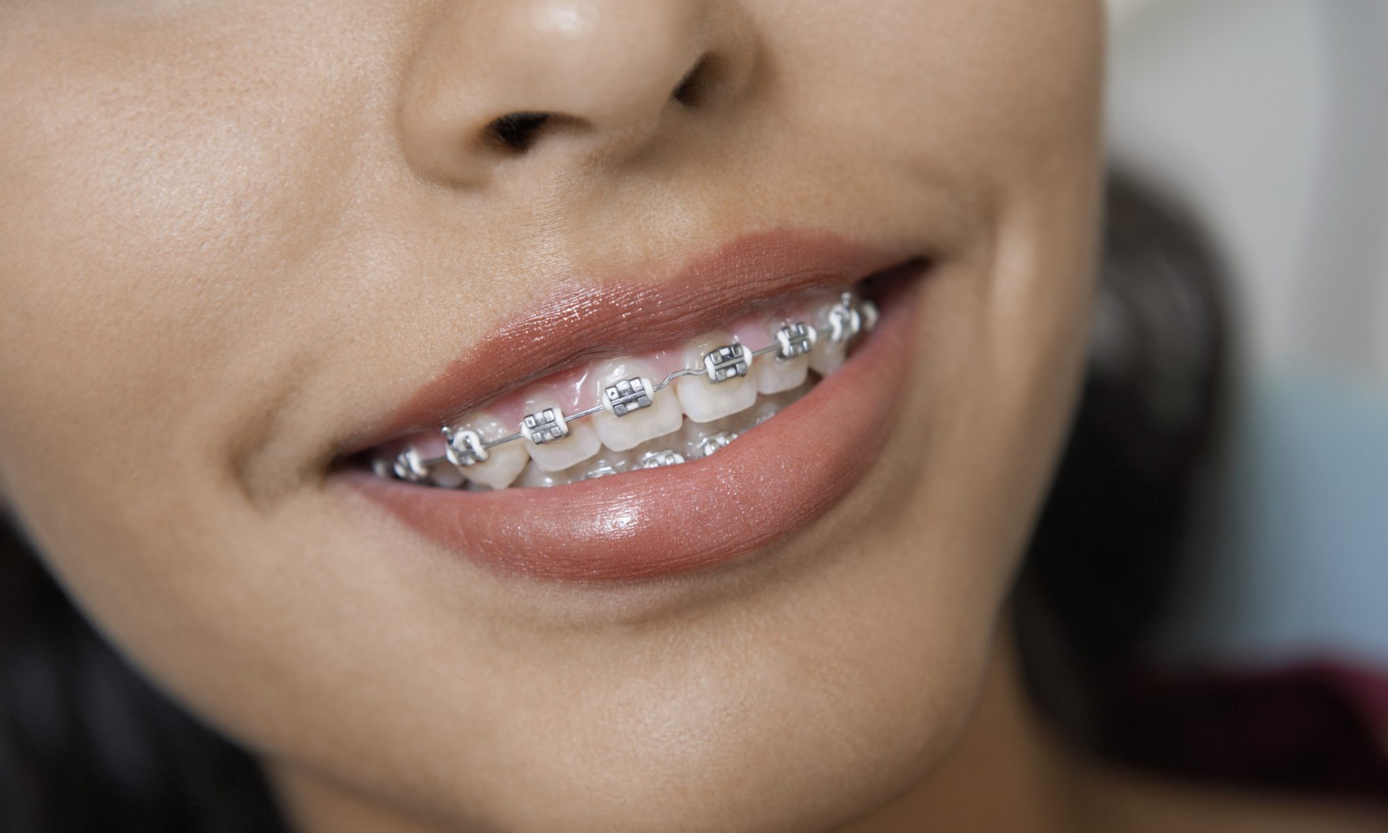 Woman smiling to show off her braces